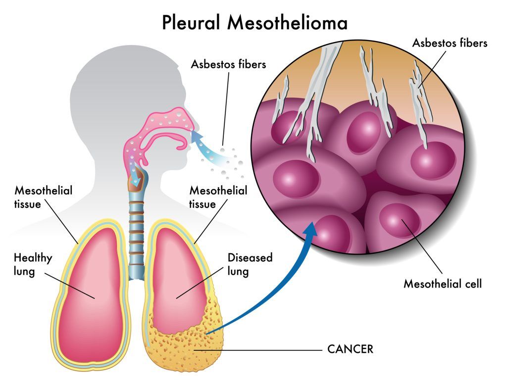 mesothelioma