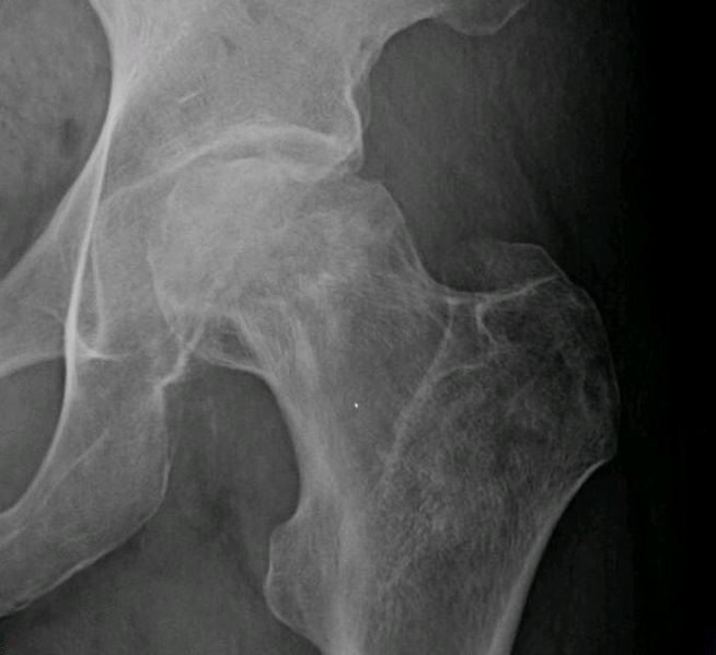 femur xray