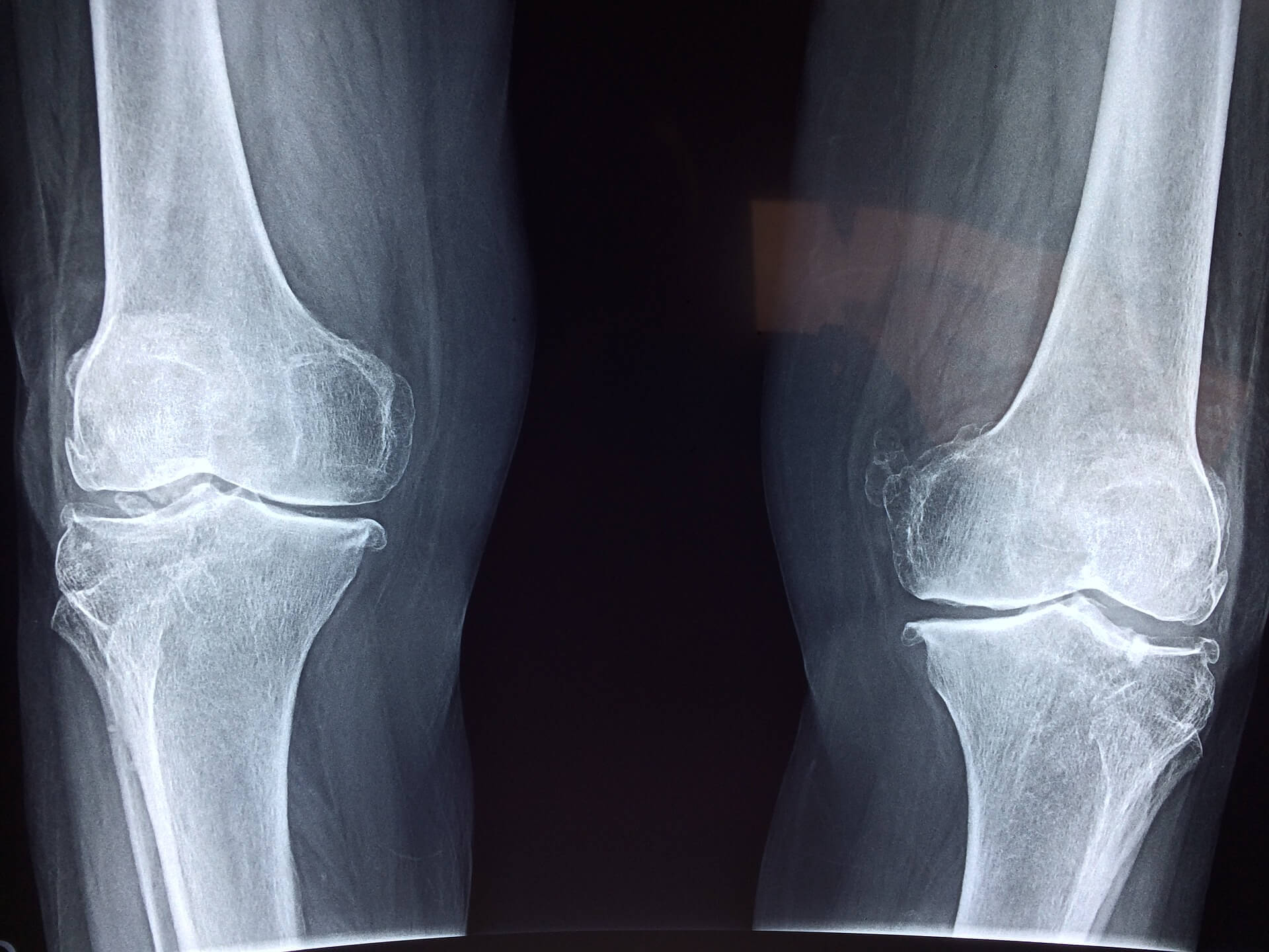 knee xray